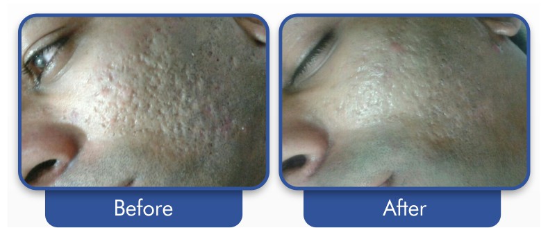 Acne Scar Treatment at Allure Aesthetics