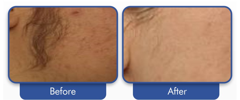 Laser Hair Removal at Allure Aesthetics