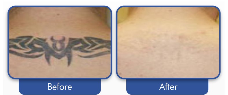 Tattoo Removal at Allure Aesthetics